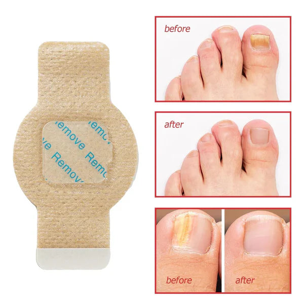 Fungal Nail Patches 🌿💅 ( Buy 1 Get 1 Free🔥🔥)