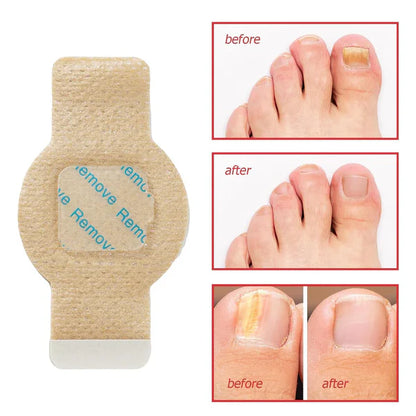 Fungal Nail Patches 🌿💅 ( Buy 1 Get 1 Free🔥🔥)
